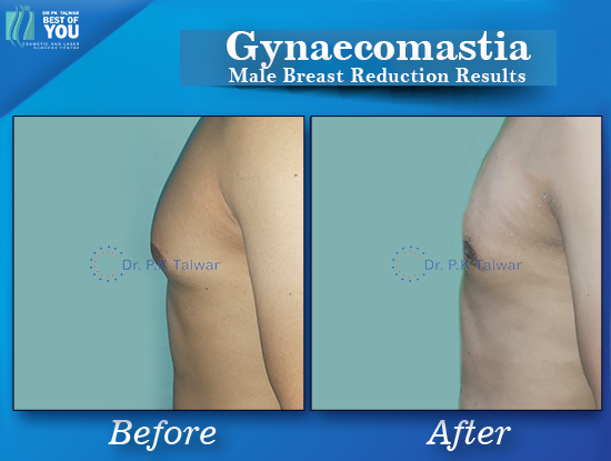 Gynaecomastia before after image